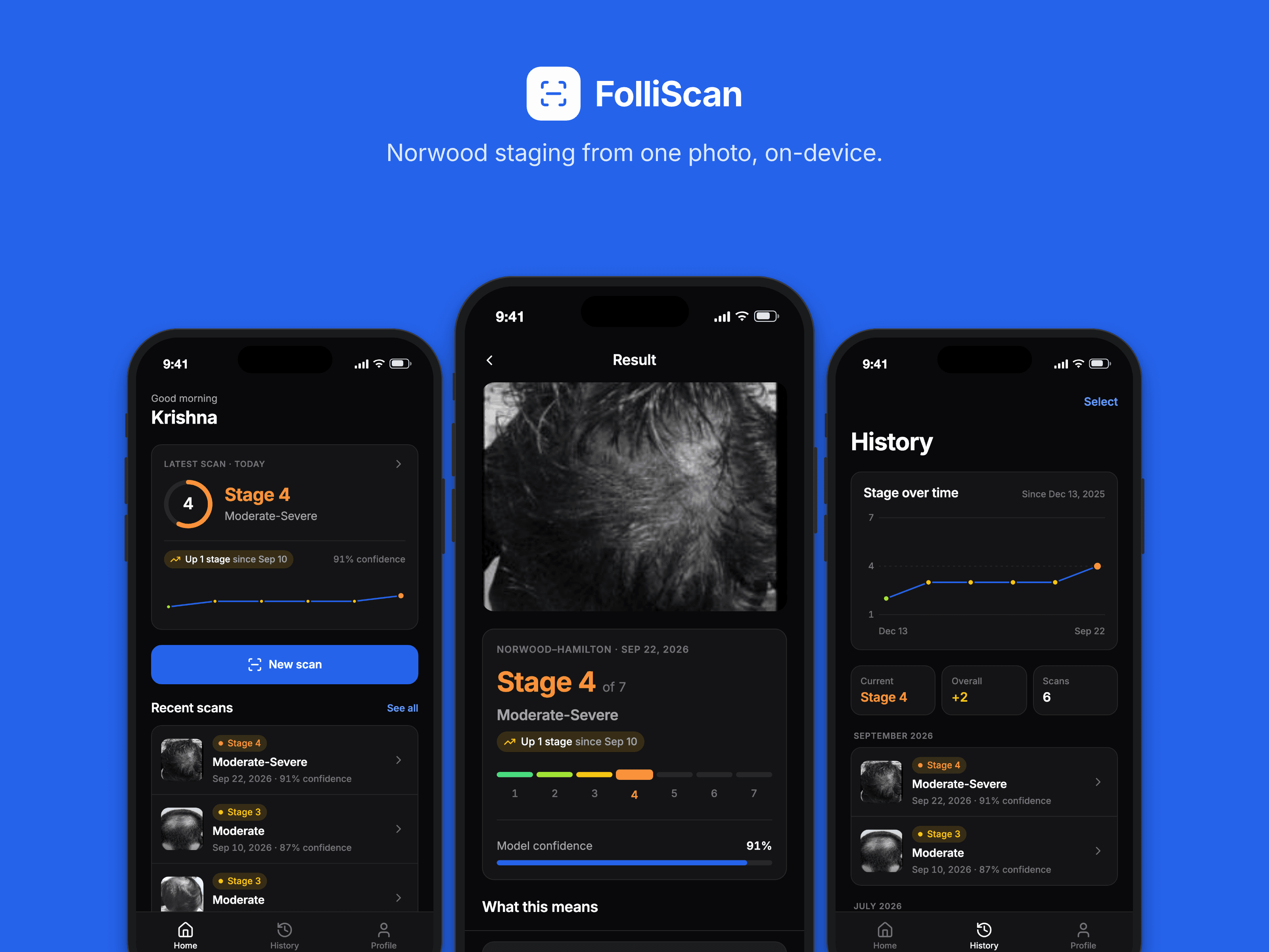 FolliScan on three phones — home, a Norwood Stage 4 result and the stage-over-time history — under the line "Norwood staging from one photo, on-device."
